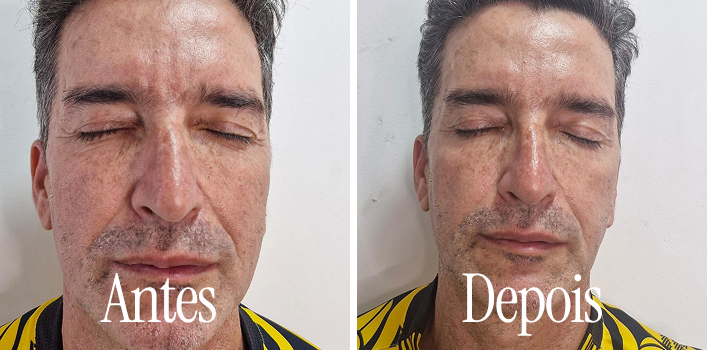 Resultado de tratamento estético