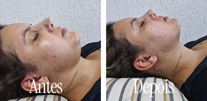 Resultado de tratamento estético