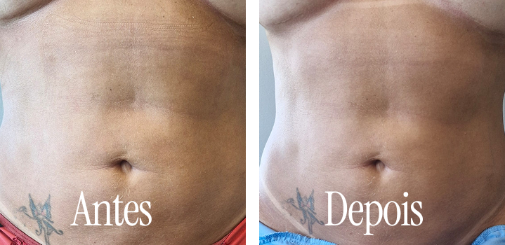 Resultado de tratamento estético