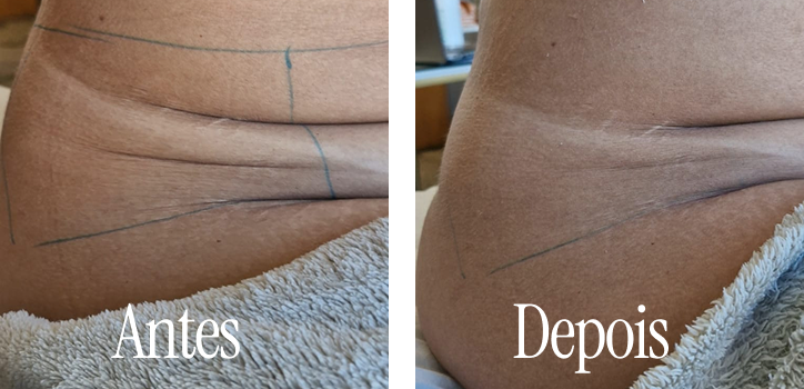 Resultado de tratamento estético